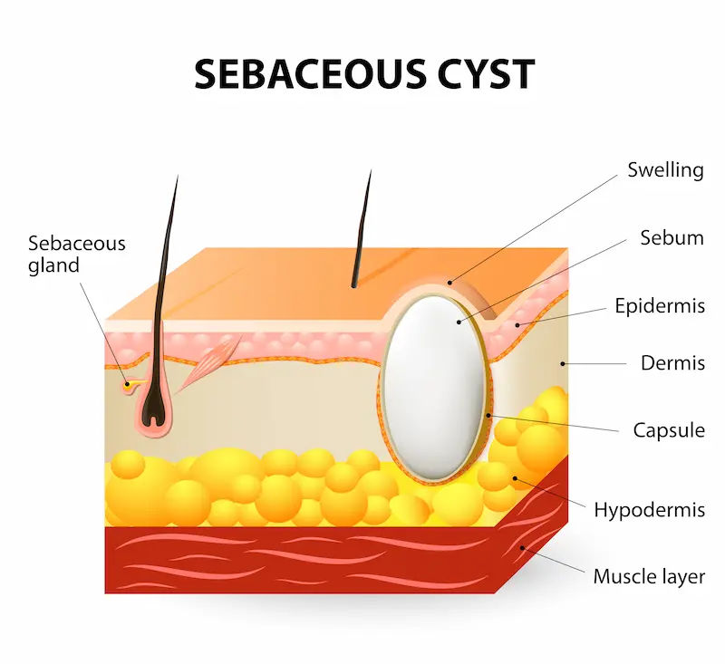 Sebaceous Cysts Symptoms, Causes and Treatment